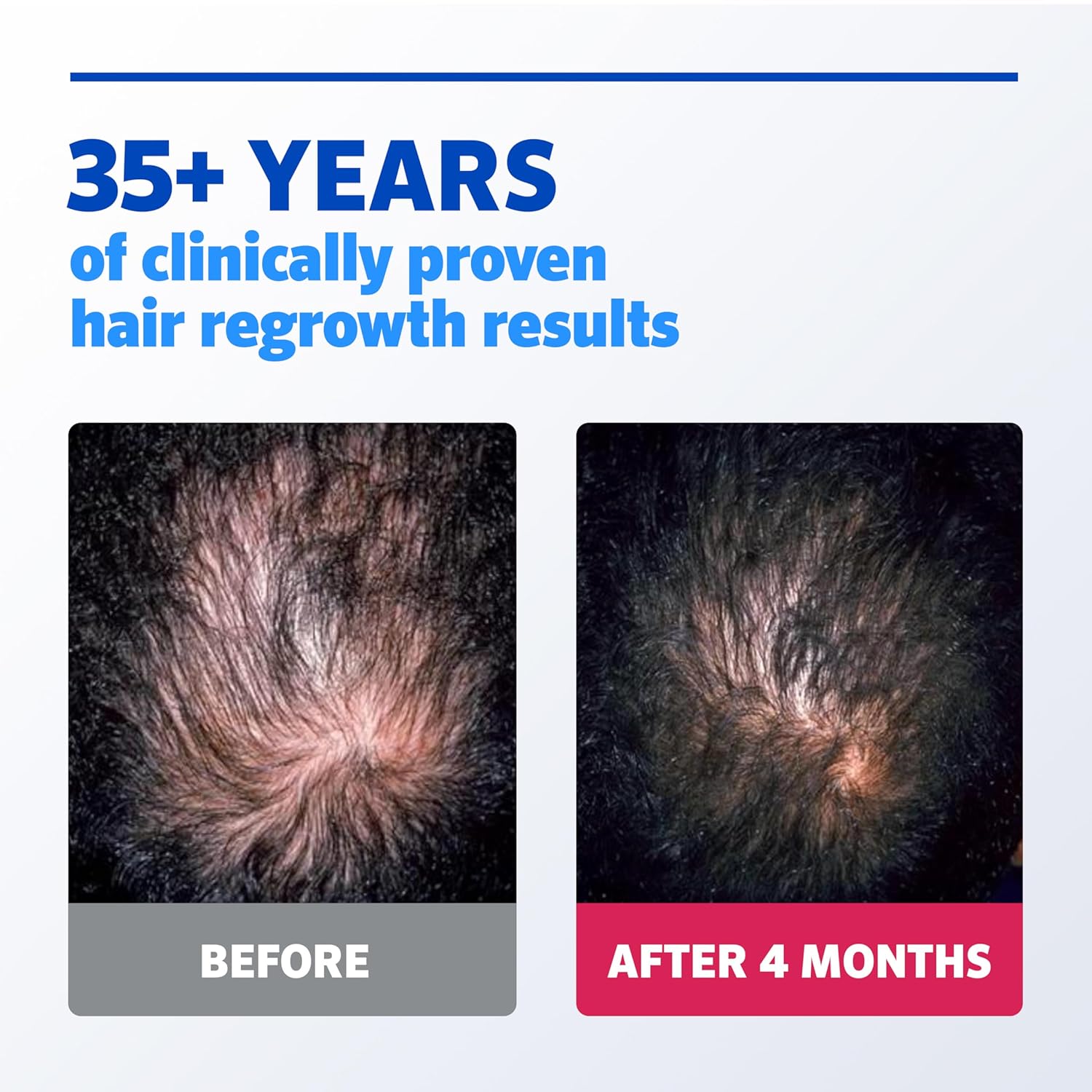 Men’s Rogaine Extra Strength 5% Minoxidil Topical Solution for Hair Loss, 3 Month Supply